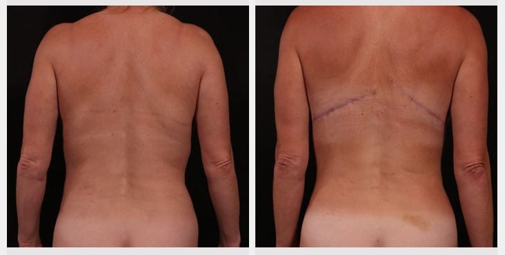 Why do some surgeons use strapping or a breast band?