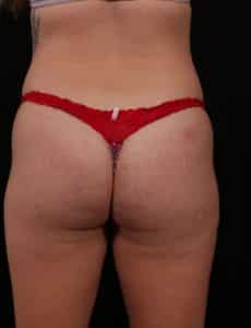 Before Image: Brazilian Butt Lift