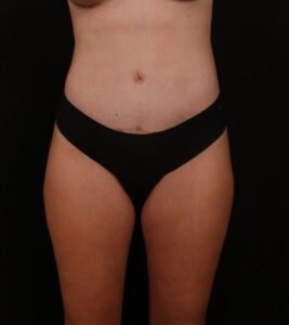 After Image: Tummy Tuck