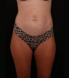 Before Image: Tummy Tuck