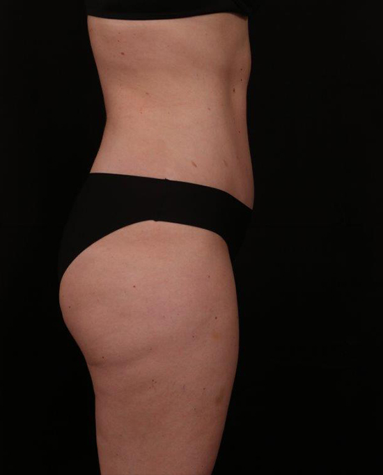 After Image: Tummy Tuck - right-side