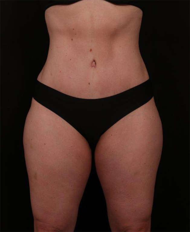 After Image: Tummy Tuck - front