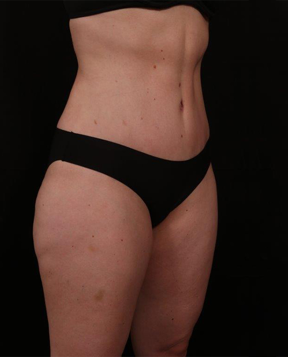 After Image: Tummy Tuck - right-front-oblique