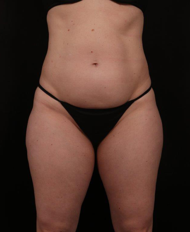 Before Image: Tummy Tuck - front