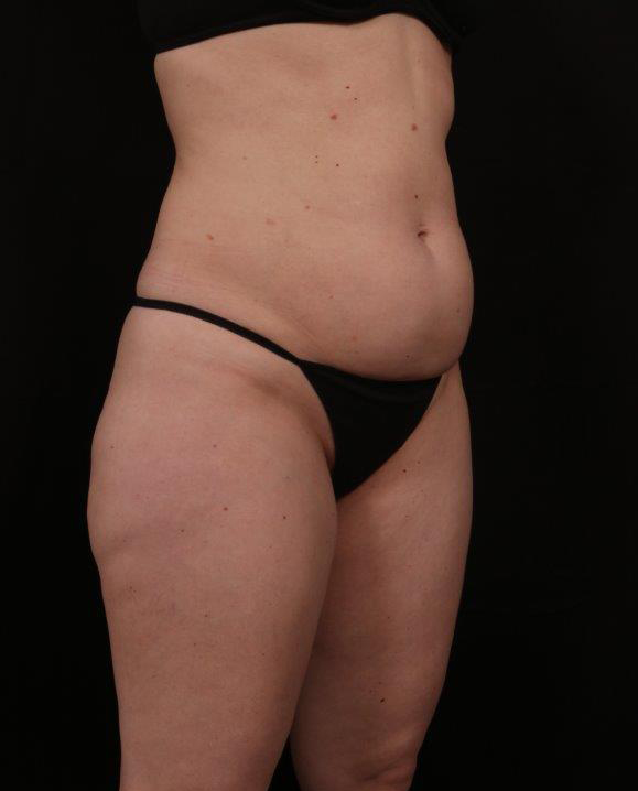 Before Image: Tummy Tuck - right-front-oblique