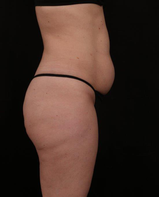 Before Image: Tummy Tuck - right-side