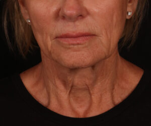 Before Image: Lower Facelift