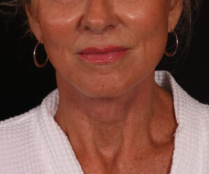 After Image: Lower Facelift