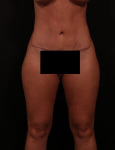 After Image: Tummy Tuck (Abdominoplasty)