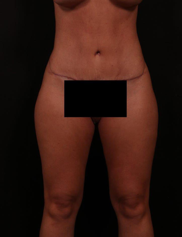 After Image: Tummy Tuck (Abdominoplasty) - front