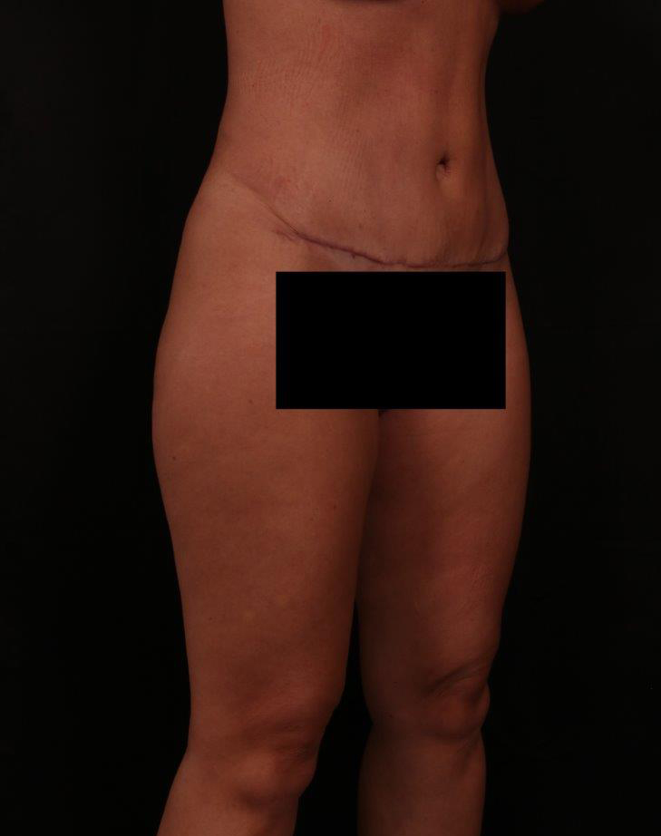 After Image: Tummy Tuck (Abdominoplasty) - right-front-oblique