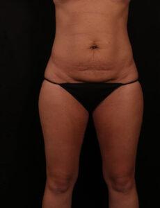 Before Image: Tummy Tuck (Abdominoplasty)