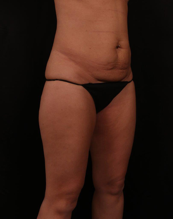 Before Image: Tummy Tuck (Abdominoplasty) - right-front-oblique