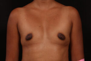 Before Image: Breast Augmentation